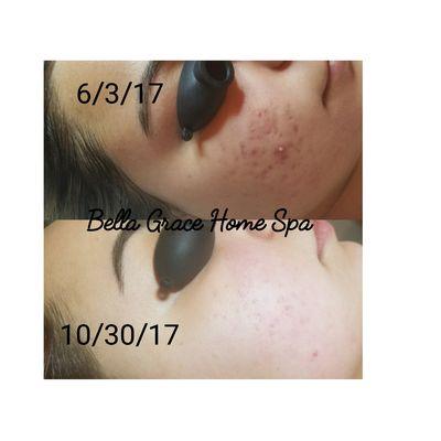 Before and after 4 microneedling treatments and the right homecare products