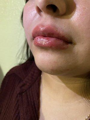 Post lip filler treatment