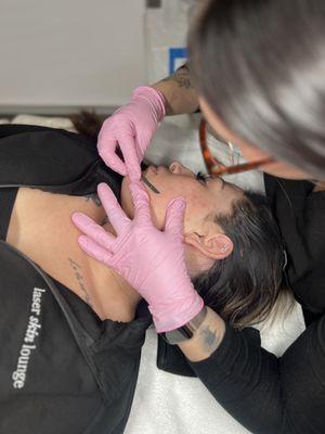 Dermaplaning