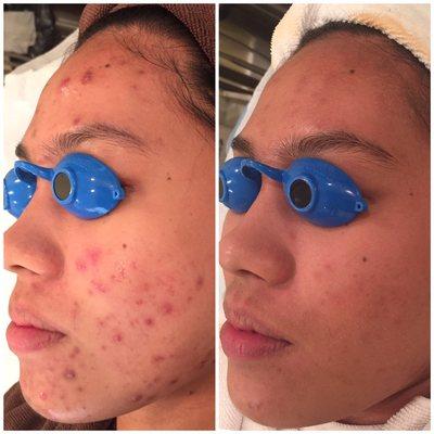 Acne Free Program