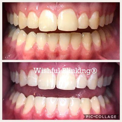 Teeth whitening now available! $99 for a limited regularly $160 Please only contact  Michele @ 216-299-5148