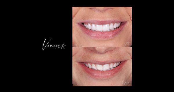 Veneers