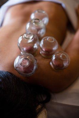 Cupping is unique in its use of counterpressure, lifting the skin and fascia and thereby releasing tension in the underlying muscles.