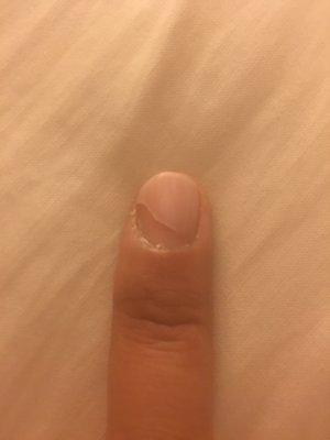 Just one of the five chipped nails after getting a no chip 5 days ago.