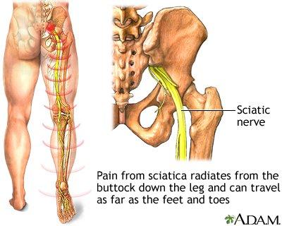 Sciatic pain