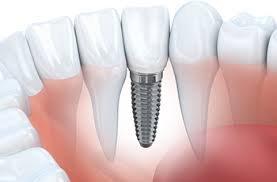 Dental Implant For $1799.00 Which Includes Exam, X-Rays, 3D Scan, 1 Dental Implant, Abutment And Crown.