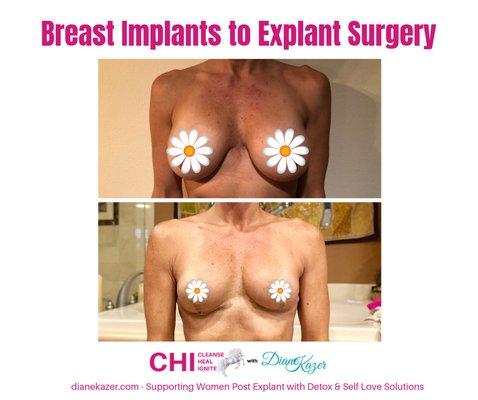 Struggling with Breast Implant Illness, even post explant? We can help.