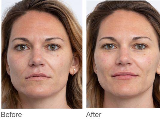 Dermal Fillers