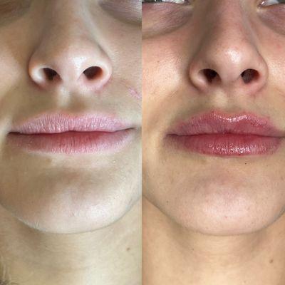 Lip Filler