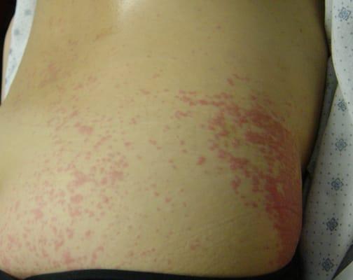 Hives: before treatment