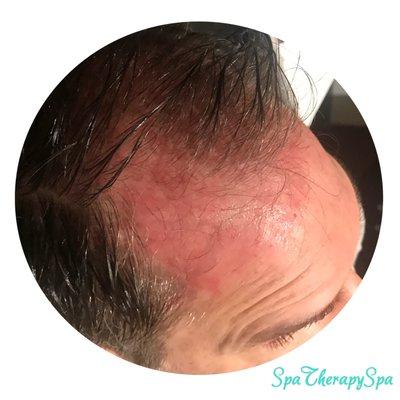 Microneedling with PRP for hair restoration.