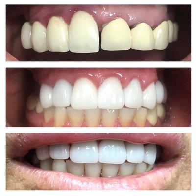 Reshape your gums and bring harmony to your smile with Emax Porcelain crowns