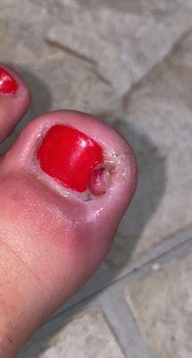 Infected toe