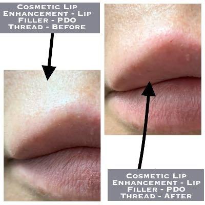 Cosmetic Lip Enhancement - Lip Filler - PDO Thread - Before-After