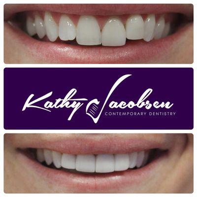 Porcelain veneers can straighten and even out the smile.