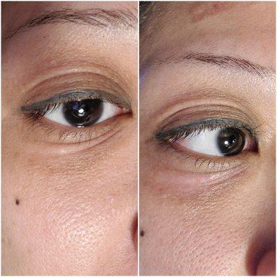 Under eye tightening before/after 3 week progression.