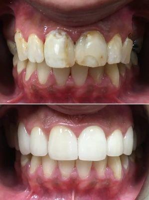 Before and after ceramic crowns