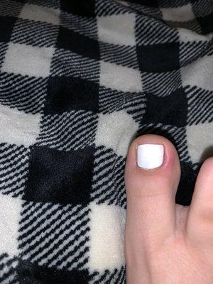 Infected/swollen toenail