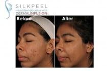 Silkpeel Dermal Infusion Microdermabrasion