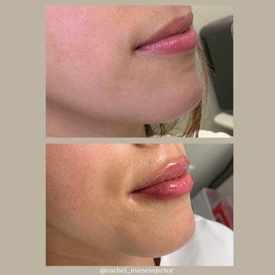 Lip filler results by Rachel Pavone, RN