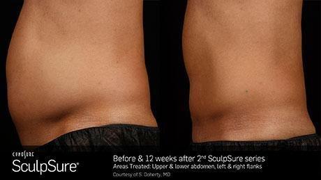 WarmSculpting with SculpSure