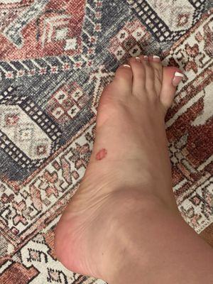 Cut on foot from the pedicure during the callus removal.