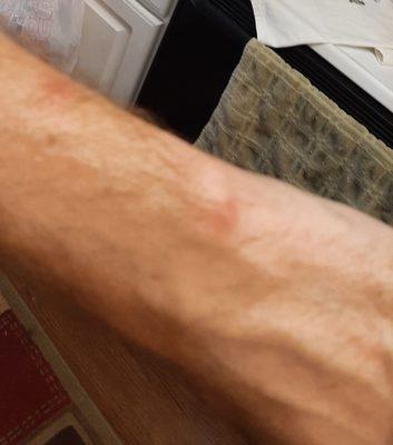 Bed bug bites on wrist and forearm