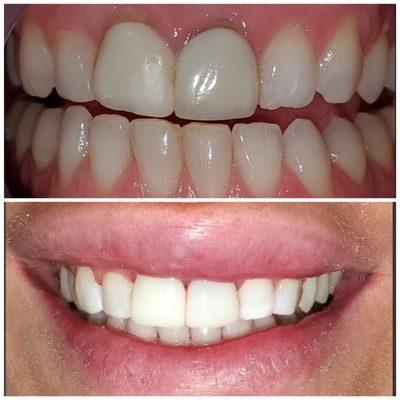 2 anterior veneers