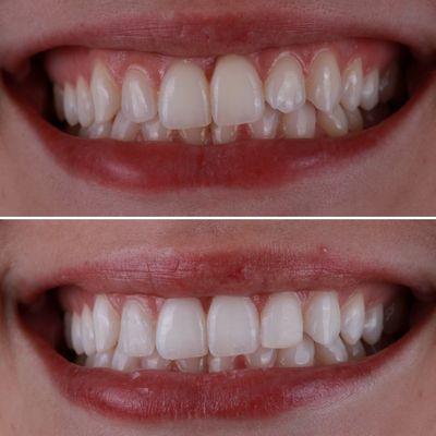 Zoom whitening & composite bonding veneers