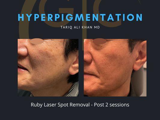 Ruby Laser for spot removal + PICO laser treatment for skin rejuvenation