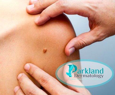 If you have any concerns about new moles, come to Parkland Dermatology.