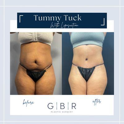 Tummy Tuck with Liposuction Virginia beach