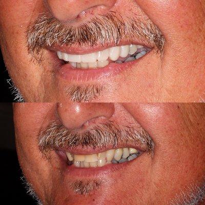 Smile Make-Over: Before and after picture. All of this done in only two appointments.