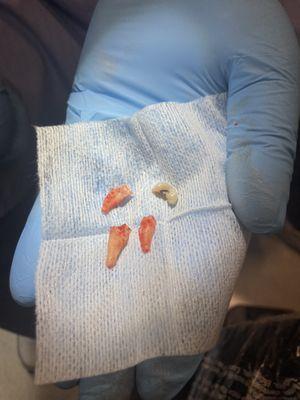 My tooth had 3 roots.