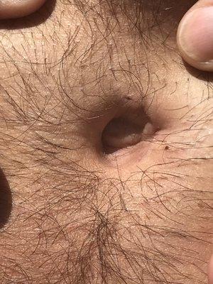 belly button incision 23 days after surgery