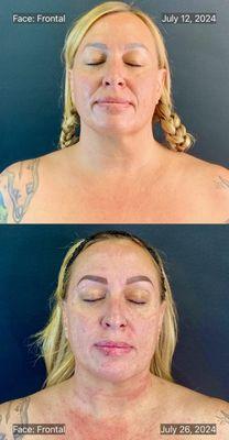 Nonsurgical Facelift