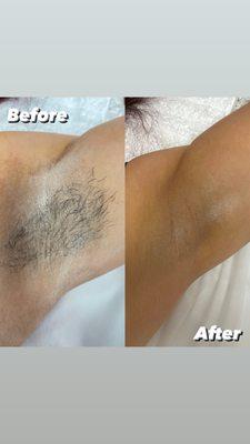 Underarm Wax with Soft Wax