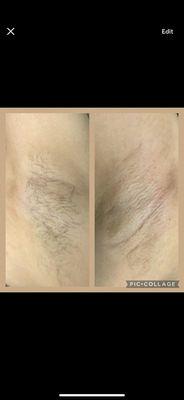 Before and after underarm wax.