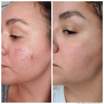 Before and after rosacea improvements