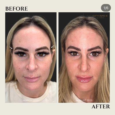 Liquid Facelift