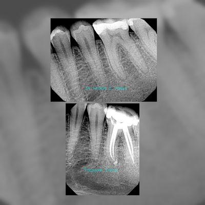 Molar root canal in one visit.