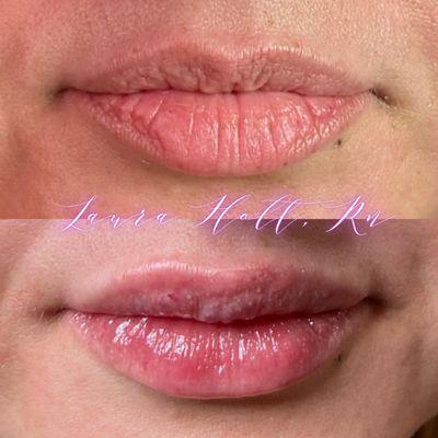 Lip Filler