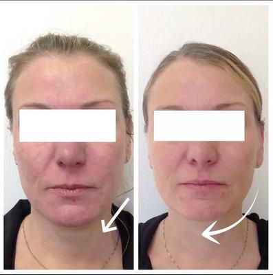 PDO Threads can help soften your face and give you a mini face lift! Call to book your free consultation today!