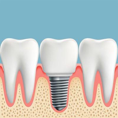 Dental Implant