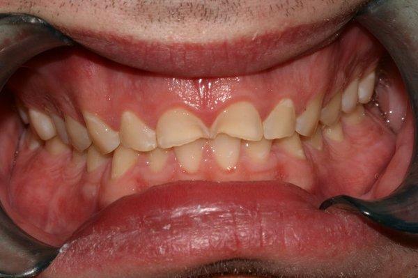 Teeth damaged from grinding