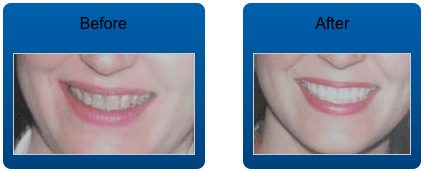 Veneers