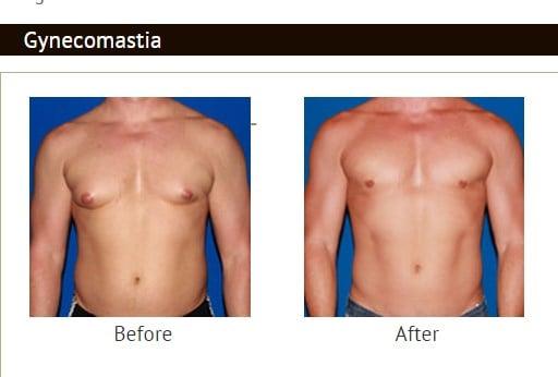 Gynecomastia male breast reduction