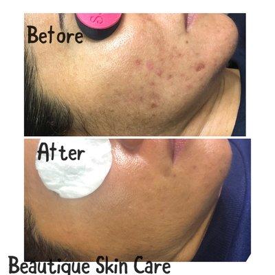 Face Reality Acne Treatment