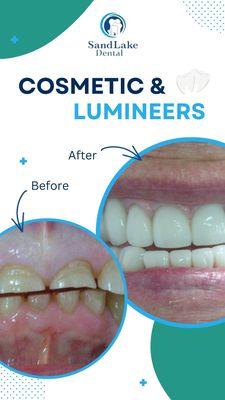 Before and After Cosmetic and Lumineers