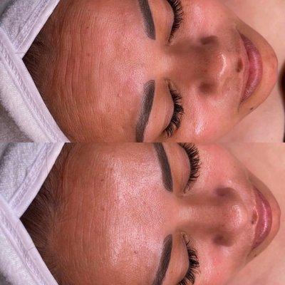 Natural "Botox" facial before and after see the deep lines reduce!